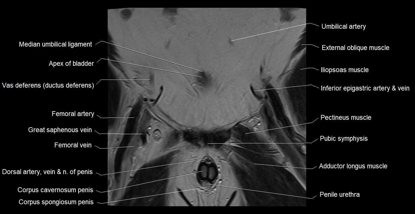 MRI coronal cross sectional anatomy male pelvis image 7.webp